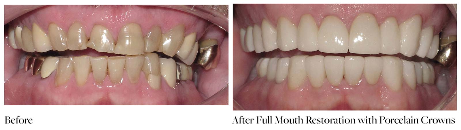 Before and after full mouth restoration with crowns