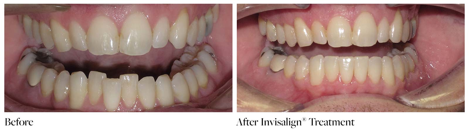 Before and after invisalign treatment teeth