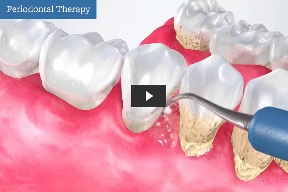 Periodontal Therapy video