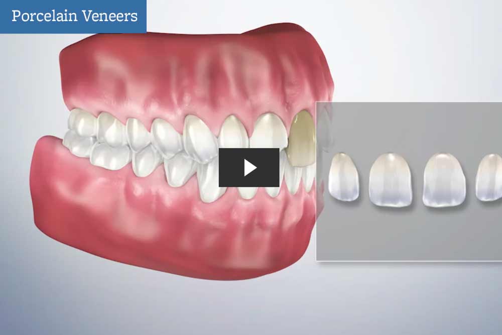 Porcelain veneers video